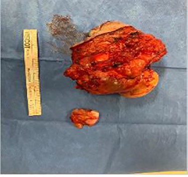 Final operative specimen.