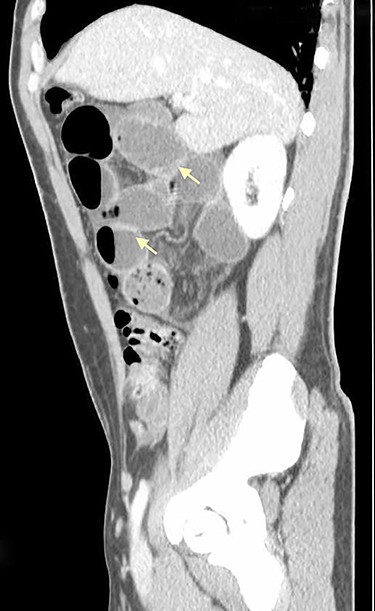 Sagittal CT scan shows small bowel distension with air/fluid levels (arrows).