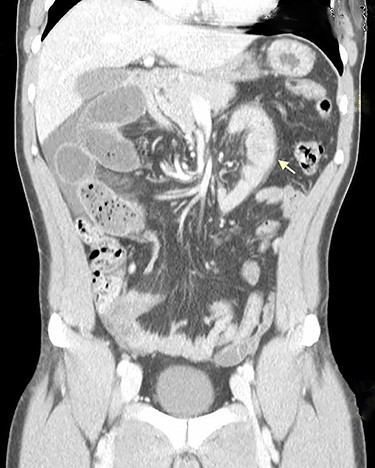 Coronal CT scan shows signs of intestinal malrotation, with alteration of the normal topography of the duodenal arch (arrow).