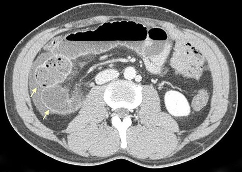 Axial CT scan shows retrocecal position of terminal ileum and free fluid in the right abdominal quadrants (arrows).