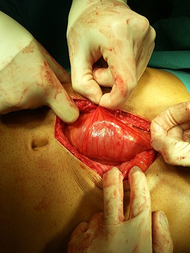Peritoneal encapsulation of the small bowel at laparotomy.