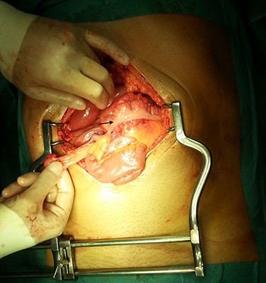 After excision of the accessory peritoneal membrane, signs of intestinal malrotation with medialization of the right colon were noted (arrow).
