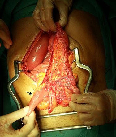 Terminal ileum in a retrocecal position leading to intestinal obstruction (arrow).