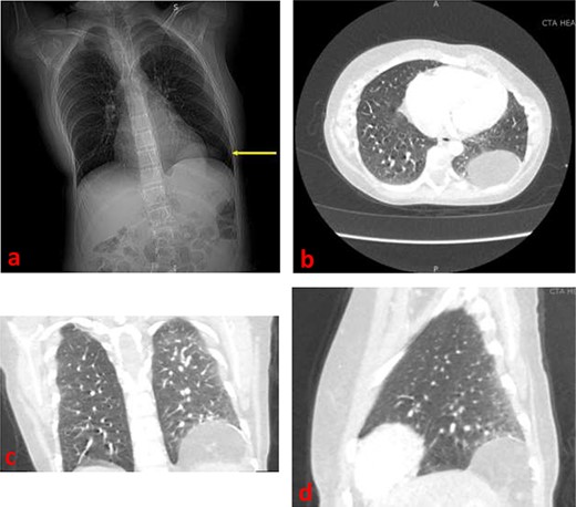 (a) Frontal chest radiograph demonstrating a left diaphragmatic hernia (arrow) (b) Axial contrast-enhanced CT image demonstrating a left diaphragmatic hernia in the left hemithorax (c) Frontal contrast-enhanced CT image demonstrating a left diaphragmatic hernia in the left hemithorax (d) Sagittal contrast-enhanced CT image demonstrating a left diaphragmatic hernia.