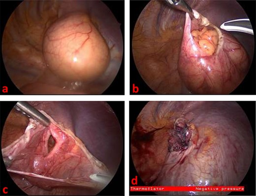 (a) Thoracoscopic view of left diaphragmatic hernia upon entry into thorax (b) Thoracoscopic view of incarcerated omentum underneath the hernia sac (c) Thoracoscopic view of diaphragmatic defect, measuring about 4 cm long, with surrounding hernia sac (d) Thoracoscopic view of repaired diaphragmatic defect.