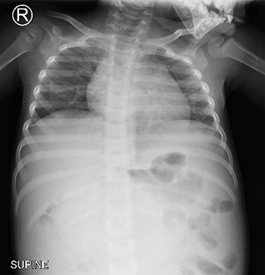Normal chest x-ray.