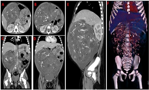 CT-scan images of axial (A,B), coronal (C,D), sagittal contrasted abdomen (E) and 3D virtual reconstruction (F); showing a large heterogenous mass occupying the abdomen and pelvis with mixed fat and soft tissue density and intratumoral calcifications displacing the air filled bowels to the left side.