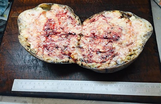 Gross appearance of the ovarian mass demonstrating an oval shape and variegated cut surface with hemorrhage and necrosis.