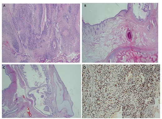 Histopathology of the immature ovarian teratoma demonstrating both immature neuroepithelial and mesenchymal elements ×40 H&E (A–C); and positive immunostaining of the immature neuroepithelium with S100 × 100 IHC, (D).
