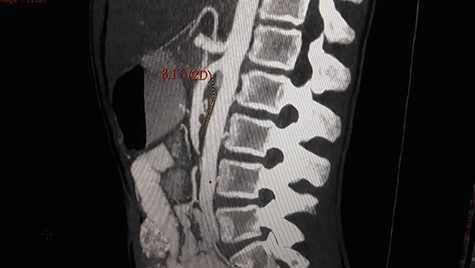 Contrast enhanced CT scan abdomen and pelvis (sagittal view) showing significant reduction of the aortomesenteric angle (measuring 8.1°) and aortomesenteric distance measuring about 7 mm.