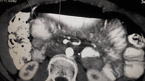 Contrast enhanced CT scan abdomen and pelvis (sagittal view) (axial view) showing duodenal compression between the aorta and superior mesenteric artery.