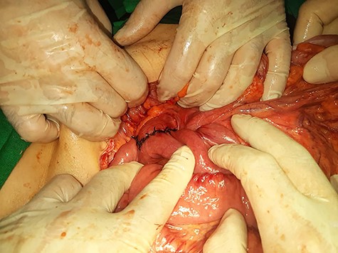 Intraoperative view of side-to-side anastomosis between duodenum and jejunum.