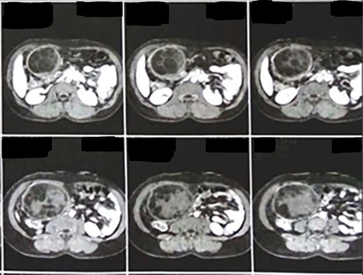CT showing a cystic mass (size: 17 × 11 cm) containing the characteristic daughter cysts and with clearly delineated reactive caps (pericystic wall).