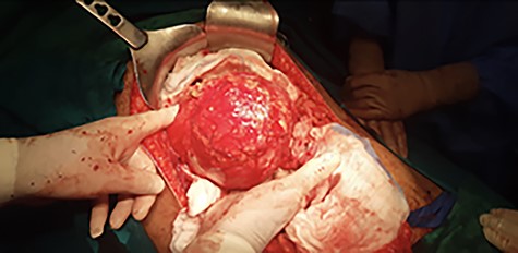 Intraoperative view showing the cystic mass covered by great omentum and adhesions.