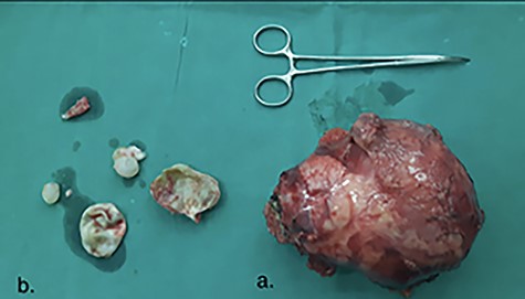 (a) The removed specimen, intact, showing the thickened outer or adventitia fibrous layer of hitine (huge cystic mass). (b) The small cyst, completely removed by opening it (endocystectomy); showing the outer cystic wall, two daughter cysts with hydatid debris material, and the inner laminated or germinal membrane.