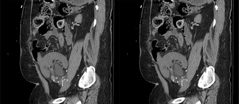 Coronal view of the CT abdomen pelvis without contrast showing hydronephrosis of the donor’s kidney.