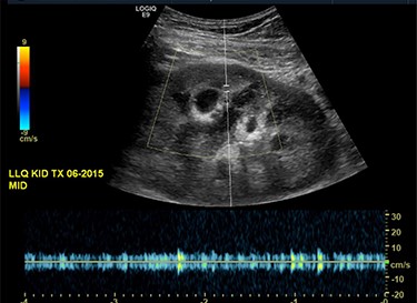 Ultrasound of the transplanted kidney showing no blood flow within the main renal artery or vein.