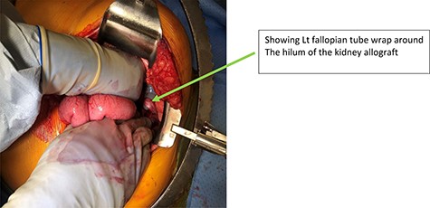 Intraoperative finding of Lt Fallopian tube strangulated the kidney allograft.