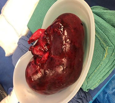 Ischemic and necrotic kidney allograft.