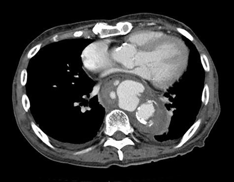 CT at the time of admission shows irregular shape of the aneurysm.