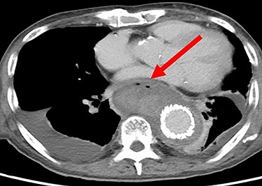 CT seven days after TEVAR. Arrow shows gas images inside the aortic aneurysm.