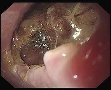 Esophagoscopy revealing an aortoesophageal fistula covered by necrotic tissue.