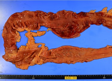 Photo of pathological autopsy. The colon shows ischemic changes such as hemorrhage, necrosis of the mucosa and loss of wrinkles.