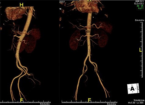 CT angiogram of abdominal aorta (sagittal plane on the left and coronal plane without bones on the right) demonstrating a narrow, hypodense SMA after the origin, raising the possibility of thrombus.