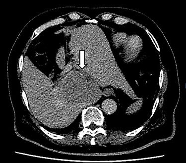 CT scan axial section delayed phase showing a 3.2 × 3.0-cm lesion (arrow) with early washout in Segment I of liver, consistent with hepatocellular carcinoma.