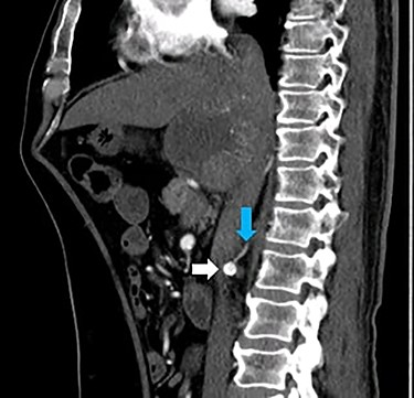 CT scan sagittal section arterial phase showing a branch (blue arrow) originating from the right renal artery (white arrow) supplying the lesion in Segment I of the liver.