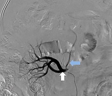 Selective catheter angiogram of right renal artery (white arrow) showing a branch near its origin (blue arrow) supplying the hepatic lesion.
