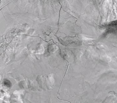 Superselective delayed phase angiogram of right renal artery using microcatheter showing well-defined tumor blush.