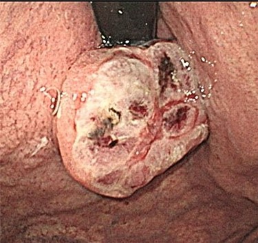 Endoscopic examination showing a large tumor with an ulcer just adjacent to the EGJ at the cardia.