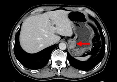 Contrast-enhanced CT showing the thickness of the gastric wall in the upper stomach (red arrow).