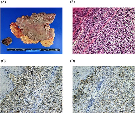 Macro-photograph and histopathological analyses of the surgical specimen. A whitish amelanotic mass with central ulceration at the EGJ and protrusion into the gastric lumen. (macro-photograph) (A). Polygonal and round neoplastic cells with round nuclei and prominent nucleoli nestled within the esophageal squamous epithelium (H&E staining, ×200) (B). The cells were positive for HMB-45 and S-100, respectively (HMB-45 and S-100 IHC staining, ×200) (C and D).