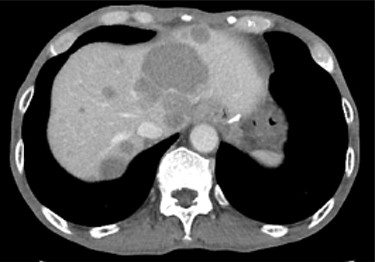 Contrast-enhanced CT showing progression of multiple cystic metastases in the liver.