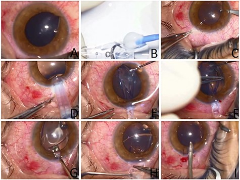 Images from the intraoperative use of soft contact lens to aid in foreign body removal. (A) Initial appearance showing location of foreign body passing through the inferior cornea and lodging behind the iris. (B) Preparing the soft contact lens with the Push-type Visian ICL STAAR injector. (C) Paracentesis next to the foreign body entry location. (D) Injection of the lens through the superior main corneal incision. (E) Adjusting the position of the SCL using a spatula. (F) Removal of the foreign body through its corneal entry site using McPherson Tying Forceps. (G and H) Careful removal of the soft contact lens. (I) Removal of Viscoelastic from the AC using a Simcoe I/A cannula.