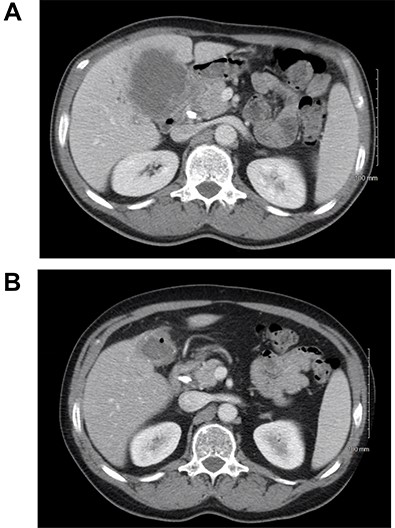 (A) CT scan of the abdomen showing the thickened gallbladder as well as a mass involving hilar hepatic parenchyma; (B) treatment response after immunotherapy.