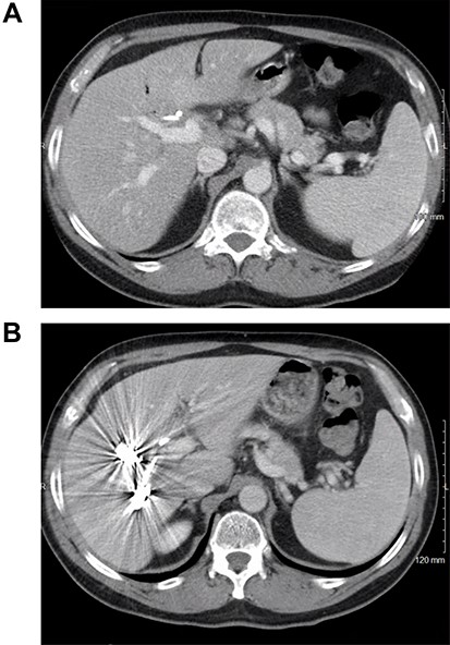 CT scan image of the liver: (A) small left lobe prior to portal vein embolization; (B) left lobe hypertrophy after right portal vein embolization.