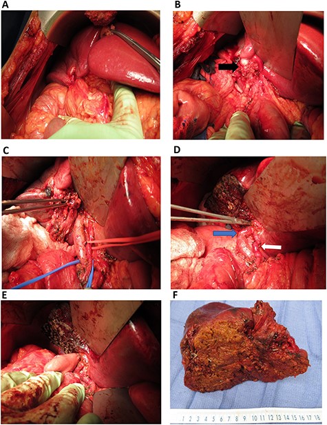 Intra-operative images: (A) omentum covering the mass in gallbladder fossa; (B) gallbladder mass (black arrow) involving the right-sided hilar structures; (C) right-sided portal structures mobilized (in the forceps); (D) after resection of the mass, left portal vein (blue arrow) and left hepatic artery (white arrow) are demonstrated. Instrument in left hepatic duct; (E) completed hepaticojejunostomy; (F) final specimen.