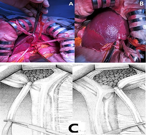 (A), (C). Temporary occlusion of the extrahepatic Glissonean pedicle using tape and silicone tube. (B) Demarcation line clearly observed on the surface after clamping.