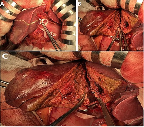 Glissonean pedicles are divided inside the parenchymal (suture–ligation) after being exposed by clamp-crush technique.