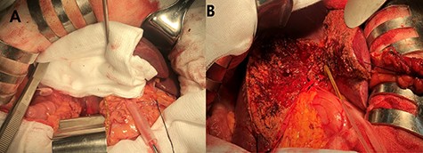 Bile leak control using (A) abdominal gauze pads. (B) Methylene blue injection via cystic duct stump.