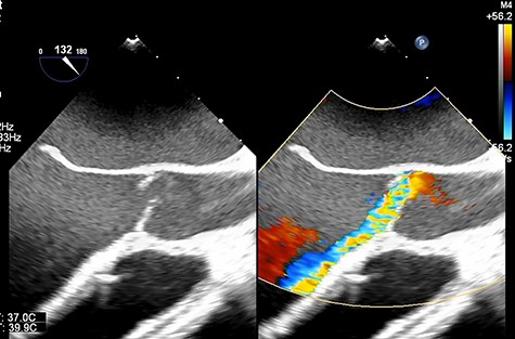 Transesophageal echocardiography showing moderate aortic insufficiency (AI) due to prolapse of noncoronary cusps after Impella removal.