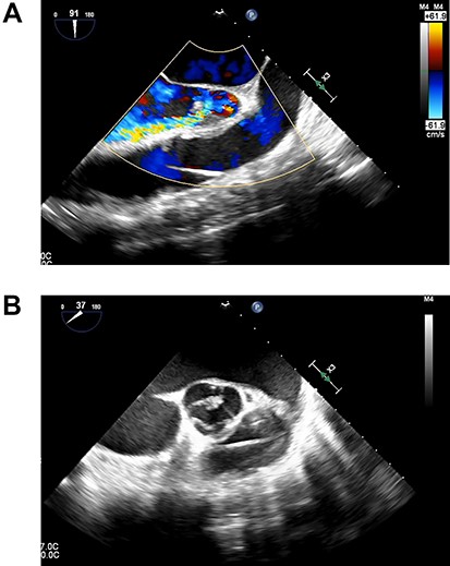 (A). Transesophageal echocardiography showing severe AI at 1 day after Heart Mate III implantation. (B). Transesophageal echocardiography showing the coaptation stitch in the right and noncoronary cusps had failed at 1 day after Heart Mate III implantation.
