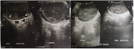Testicular ultrasonography result.