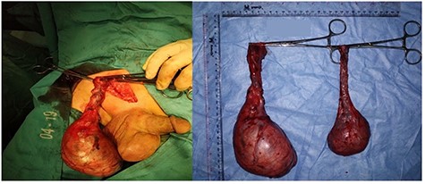 Gross morphology of right and left testicular tumours.
