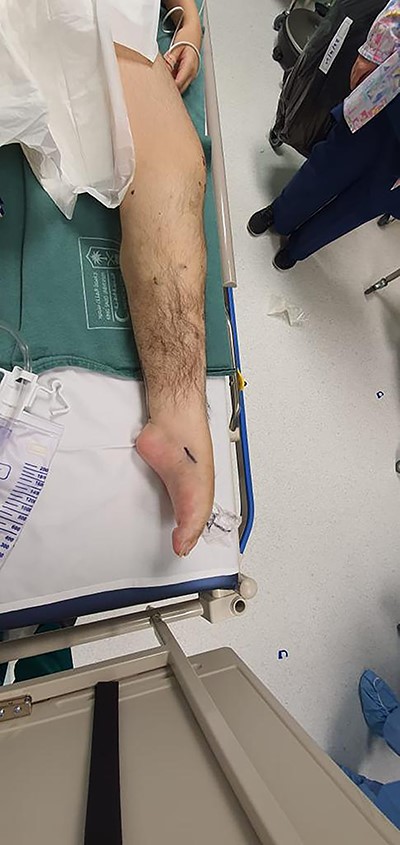 Side photo for the left lower limb showing severe cavus of the foot.