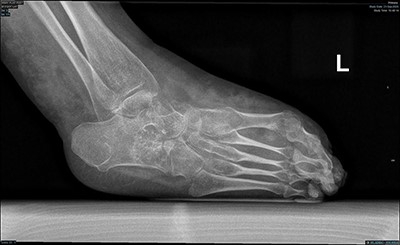 Lateral weight bearing radiograph showing severe pes cavus with osteopenia and soft tissue swelling.