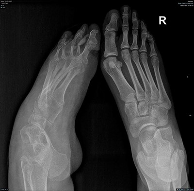 AP radiograph of both feet showing cavovarus deformity of left foot and right hallux valgus.